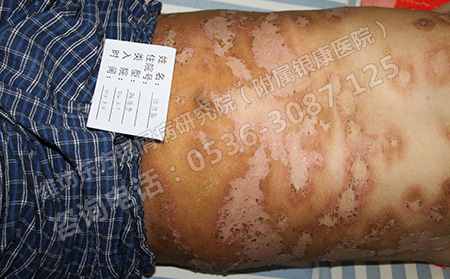 银屑病为什么会出现误诊