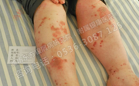 寻常型牛皮癣久治不愈的原因是什么