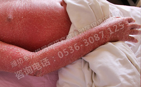济南患者春季银屑病护理方法有多少