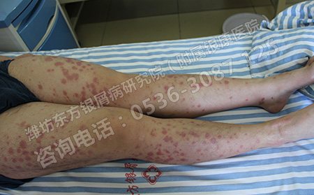 济南银屑病患者理想抽烟吗