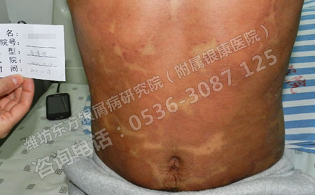 哪些方法理想帮助济南银屑病患者避免复发