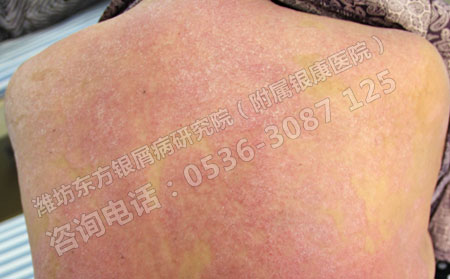 牛皮癣患者全身发病的原因是什么