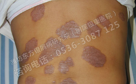 女孩子怎样理想减少银屑病带来的伤害?