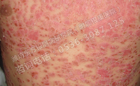 银屑病患者如何进行自我护理