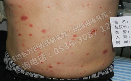 银屑病临床治疗有三招