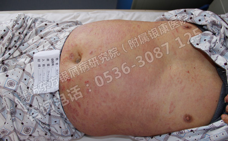 银屑病患者在日常生活中如何控制饮食