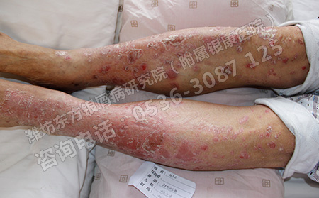 孩子得了银屑病要如何有效治疗