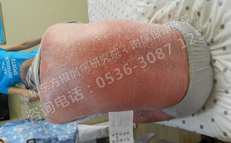 银屑病患者的皮肤如何进行护理