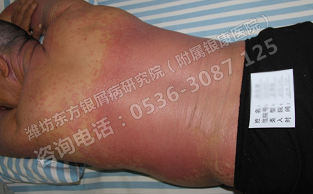 日常生活中银屑病患者常用的护理方法有哪些