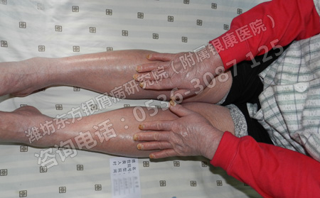 如何防止银屑病在急性进行期泛发全身呢