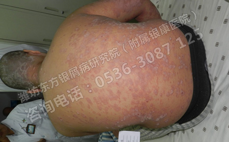 银屑病扩展全身应该怎么治疗