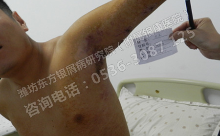 济南预防银屑病有没有比较理想的方法呢