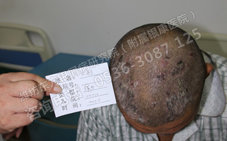 头部牛皮癣患者夏天如何护理