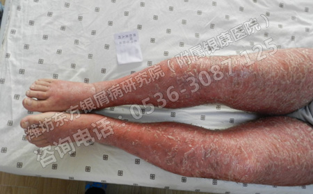 寻常型牛皮癣用什么方法治疗能尽快恢复