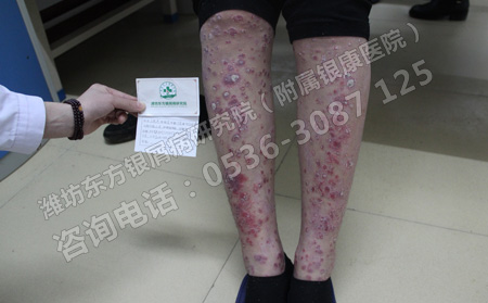 银屑病患者应该加强保健