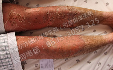 夏天有利于牛皮癣病情的食物