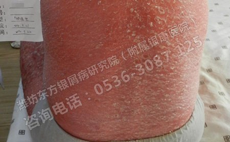 夏天治疗牛皮癣有什么理想的办法