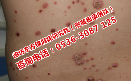 如何治疗重症牛皮癣