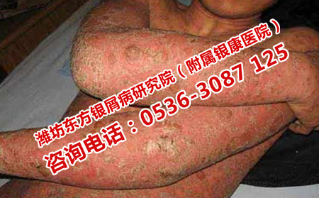 牛皮癣患者的饮食误区