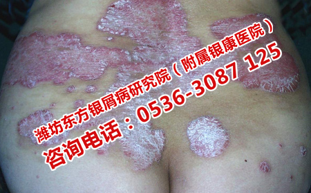 济南看牛皮癣理想的医生在哪里