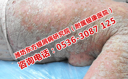 治疗严重银屑病有效的方法