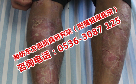 如何消除红皮型牛皮癣
