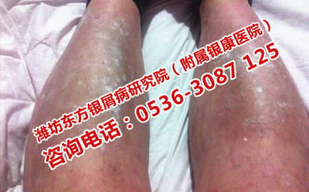 乱用激素对牛皮癣的危害