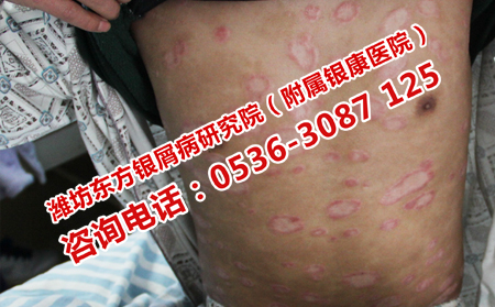 济南牛皮癣医院治牛皮癣多少钱