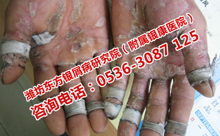 牛皮癣恢复后期的瘙痒症状