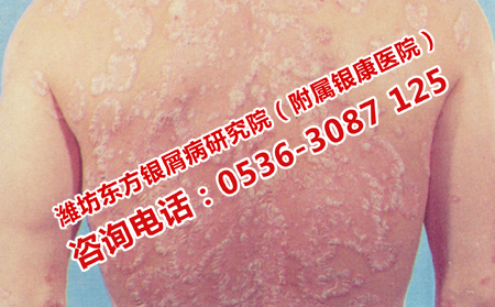 护理牛皮癣的三大方面