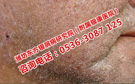 银屑病能不能治理想呢