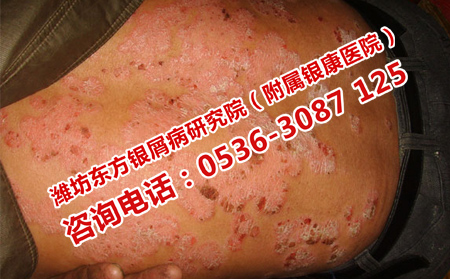 uvb治疗银屑病如何
