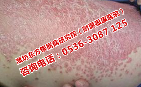 济南哪里有治疗牛皮癣的