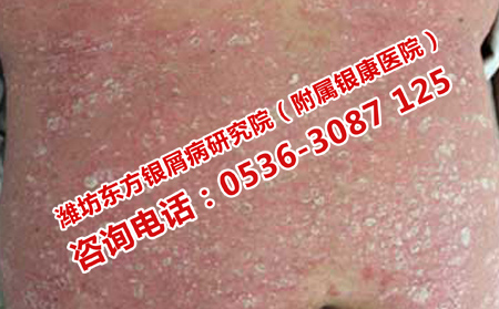 济南哪家医院治疗牛皮癣理想