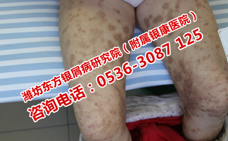 中医治疗牛皮癣的有效方法