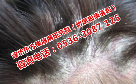 长清能治理想牛皮癣吗