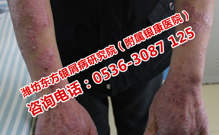 钢城银屑病多久能全理想