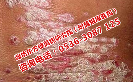 长清理想的牛皮癣医院
