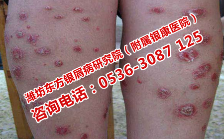 治疗银屑病什么方法理想