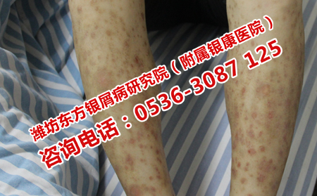 牛皮癣治疗费用问题