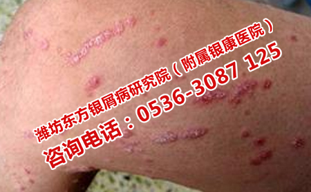牛皮癣治疗指南