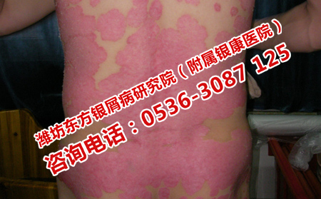 长清治红皮型银屑病的医院