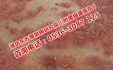 设么样的医院治银屑病有效