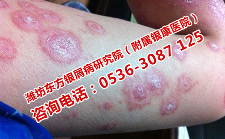 全身硬币大小银屑病的治疗