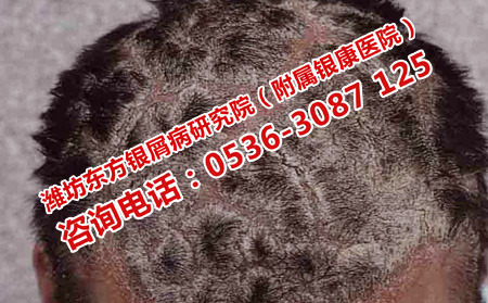头部银屑病的护理细节