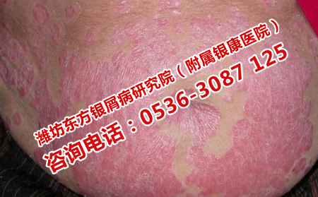 济南银屑病医院治疗全身银屑病