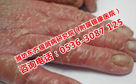 济南银屑病医院电话