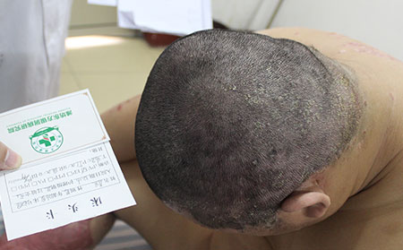 济南银屑病患者治疗头部银屑病