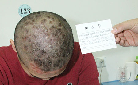 银屑病如何护理理想