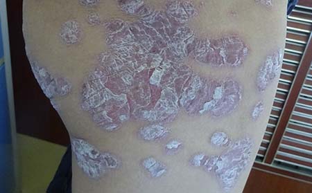 寻常型牛皮癣,济南市银屑病医院,济南哪治疗银屑病好
